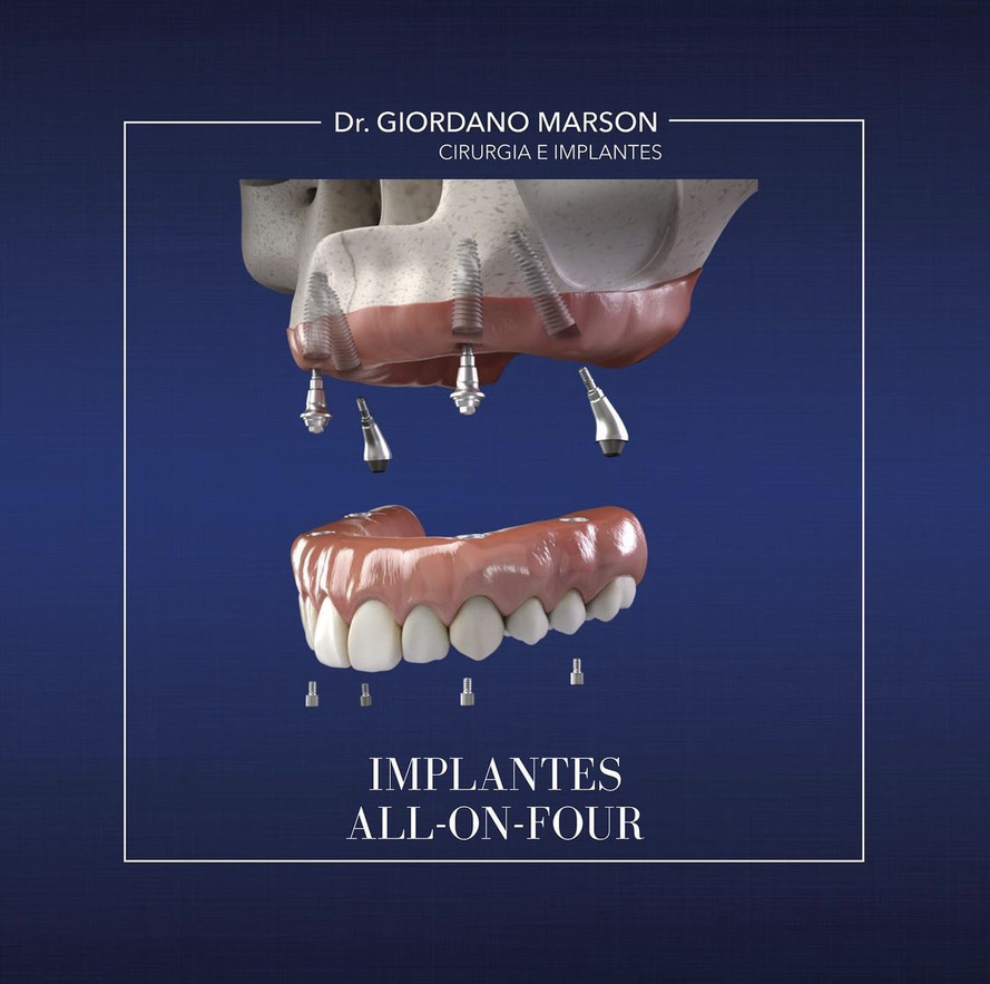 Caso clinico All-on-Four Maxila