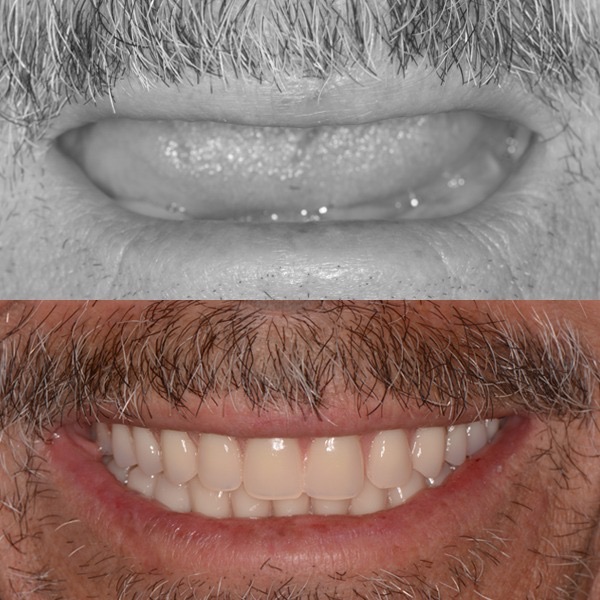 Antes e depois de protocolo sobre implantes - Caso 1