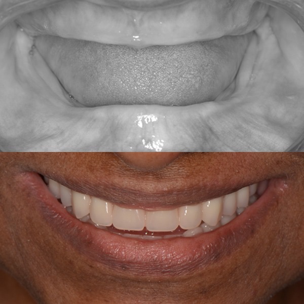 Antes e depois de protocolo sobre implantes - Caso 2