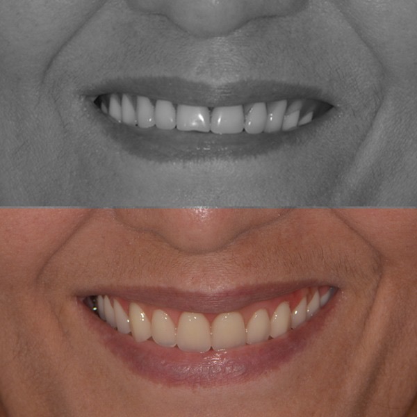 Antes e depois de protocolo sobre implantes - Caso 3