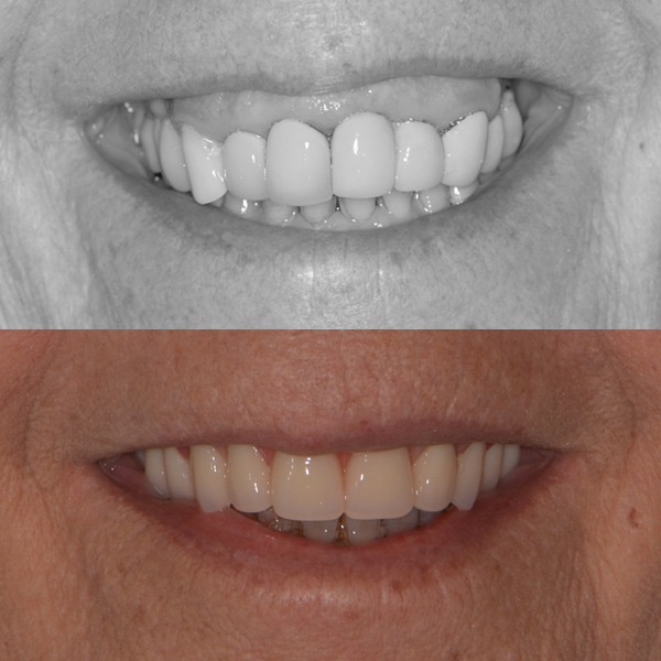 Antes e depois de protocolo sobre implantes - Caso 4