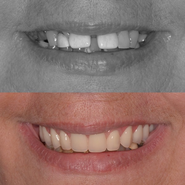 Antes e depois de protocolo sobre implantes - Caso 5