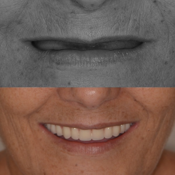 Antes e depois de protocolo sobre implantes - Caso 6