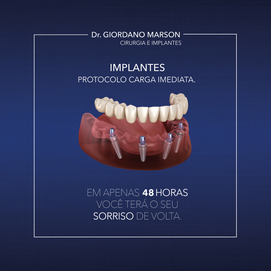 Caso clinico Carga Imediata - Protocolo em 48h