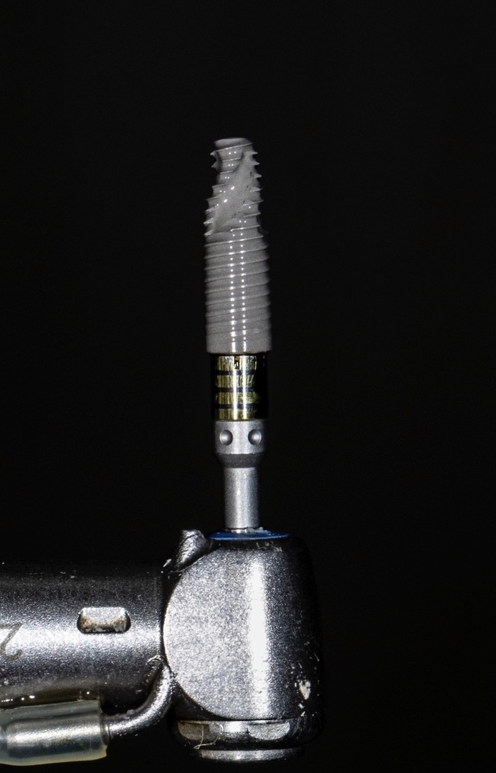 Caso clinico Implante Dentario